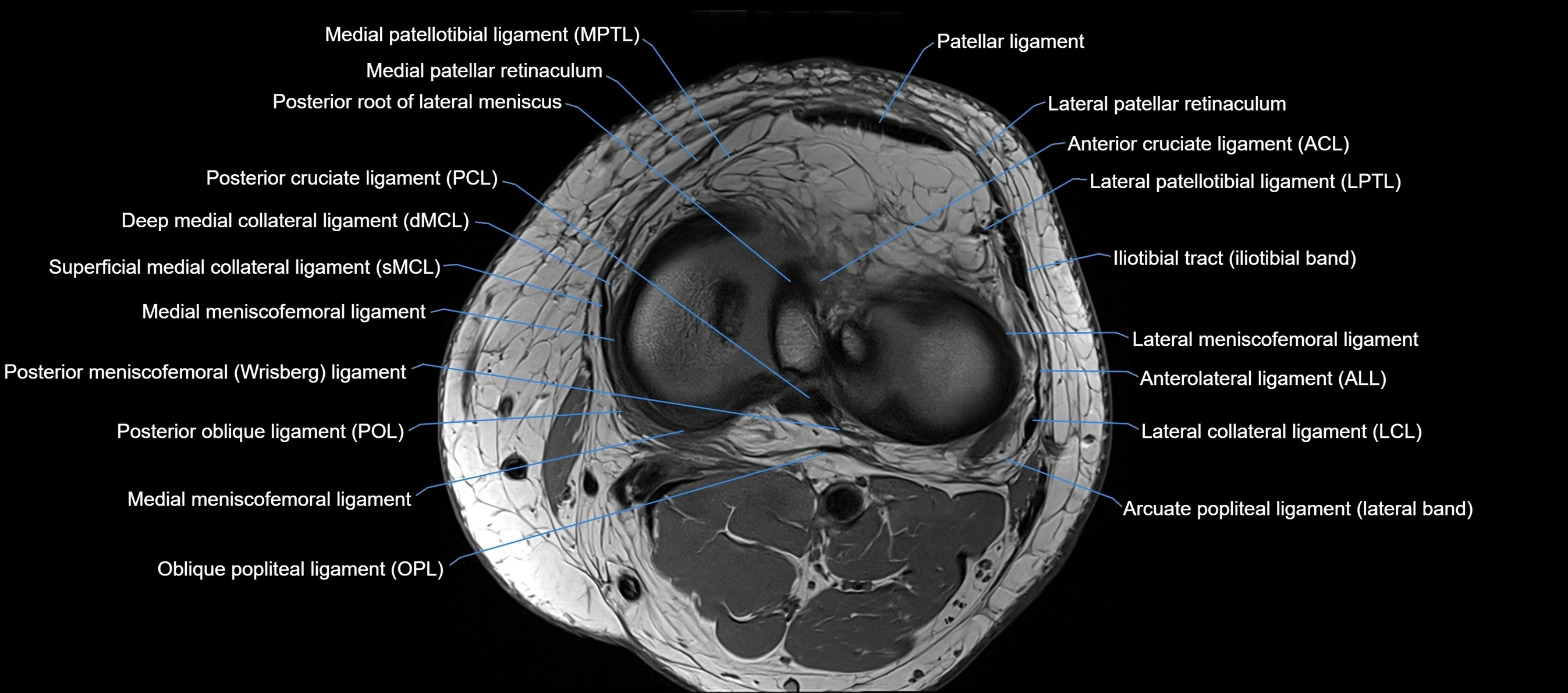 MRI Knee axial  ligaments cross sectional anatomy 3T  radiology  image-img-03001-00029.webp